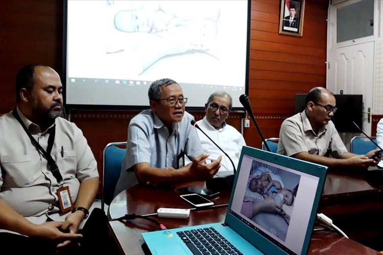 Tim dokter RSUPHAM Medan menjelaskan operasi pemisahan yang akan dijalani bayi kembar siam Adam dan Malik pada Selasa (23/7/2019) 