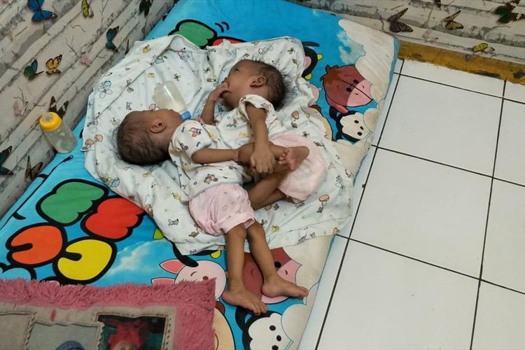 bayi kembar siam yang diberi nama Ahmad Rahman Al Ayyubi dan Ahmad Rahim Al Ayyubi di Kota Bekasi, Rabu (31/7/2019).