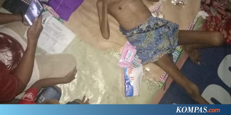 Bocah 13 Tahun di Depok Meninggal Dunia Disebabkan Gizi Buruk
