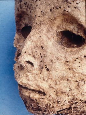 Mummy Italia buktikan infeksi hepatitis b 450 tahun lalu