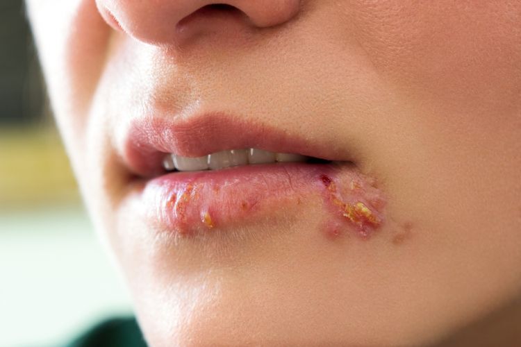 herpes sudah kering tapi masih gatal