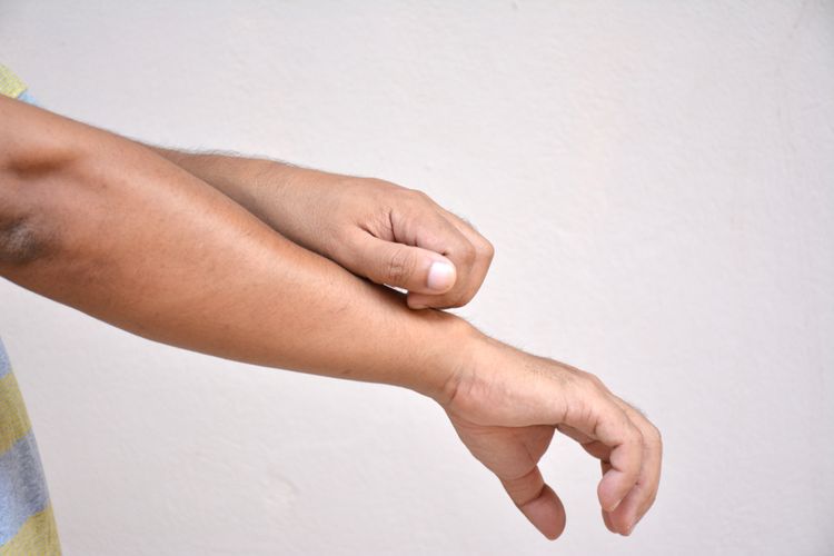 Ilustrasi dermatitis atopik, gatal, ruam