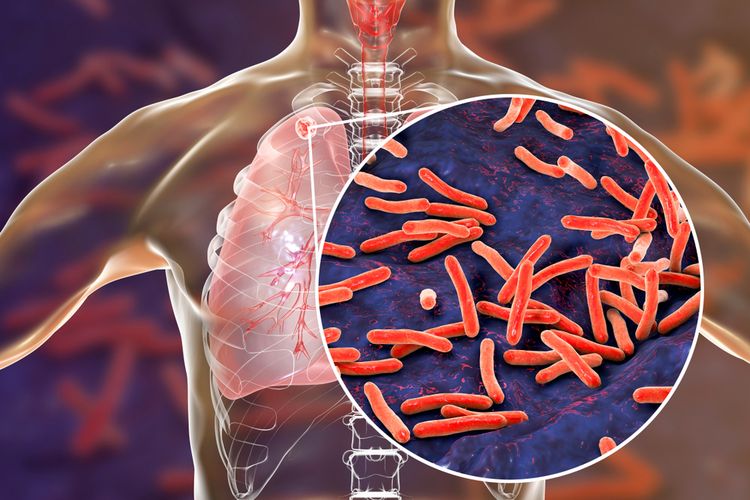 Ilustrasi paru-paru pasien pengidap tuberkulosis (TB) paru, dengan tampilan diperbesar bakteri Mycobacterium tuberculosis yang menyebabkannya.