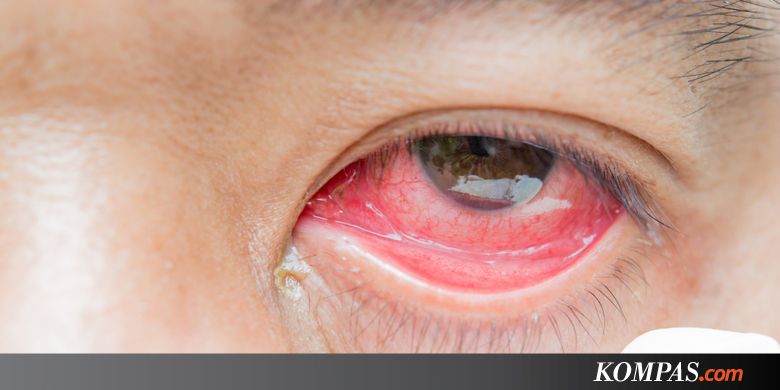 Viral Foto Mata  Merah  karena  Pembuluh Pecah akibat Main 