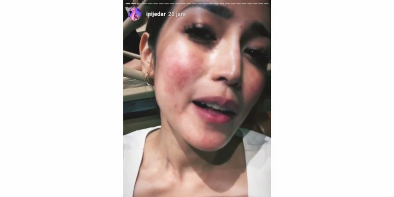 Wajah Jessica Iskandar memerah karena alergi anestesi.