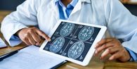 Penyakit Moyamoya, Penyebab Stroke Tak Biasa di Usia Muda