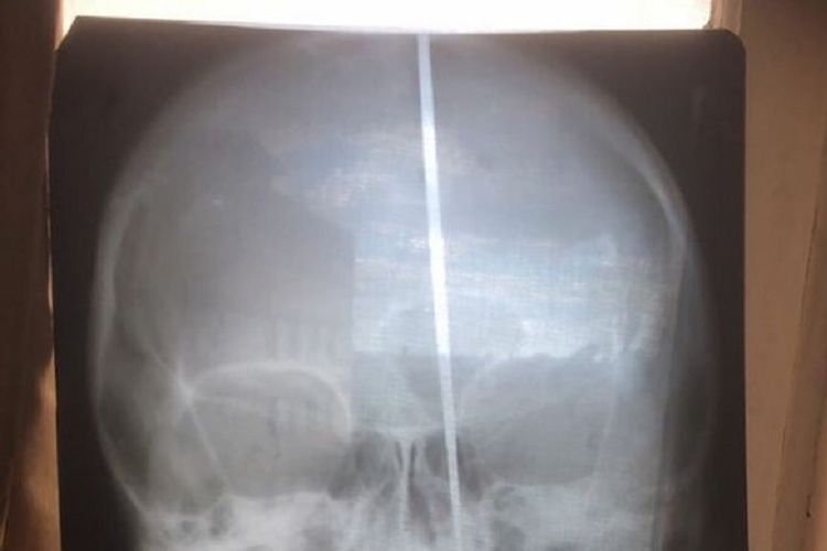 Hasil pemeriksaan sinar X memperlihatkan pisau yang menancap di kepala seorang pria.