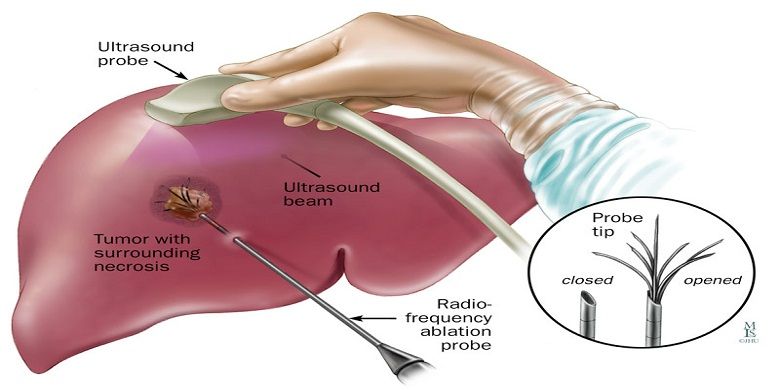 Radiofrequency Ablation (Rfa): Membunuh Kanker Seperti Terbungkus Dalam Api