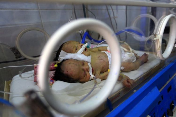 Bayi siam berjenis kelamin laki-laki, Abdel Khaleq dan Abdel Karim, berada di inkubator di rumah sakit di Sanaa pada Rabu (6/2/2019). (AFP/MOHAMMED HUWAIS)