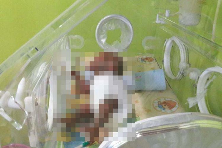 Bayi umur 4 hari tanpa kulit luar masih dirawat dalam inkubator di Rumah Sakit Bahteramas Kendari.