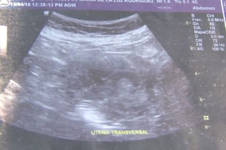 Inilah hasil ultrasound yang diperlihatkan Maria de la Luz. Perempuan ini mengklaim hamil enam bulan dalam usia 70 tahun.