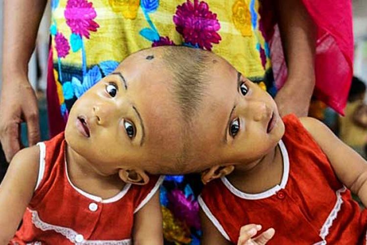 Rabia dan Rukia, bayi kembar siam menempel di tengkorak yang lahir di Banglades setahun lalu, akan menjalani operasi yang sulit, dan berpotensi membahayakan nyawa keduanya.
