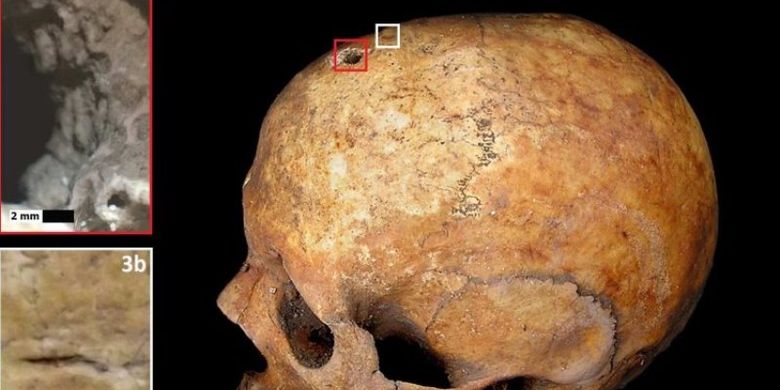 Trepanasi, pengeboran di kepala yang dipercaya dapat mengobati berbagai penyakit.