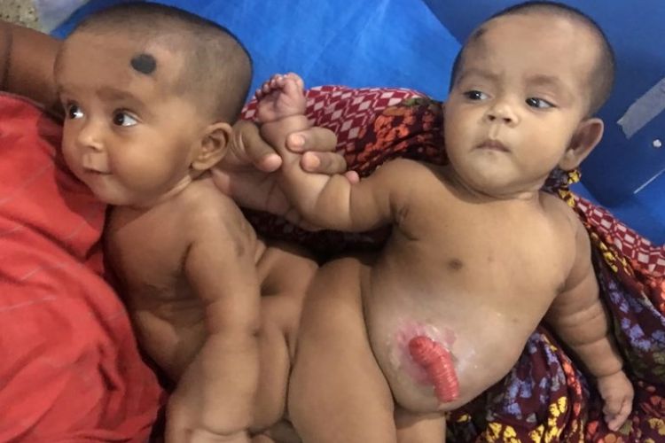 Bayi kembar siam Tofa dan Tahura yang dipisahkan tim dokter sebuah rumah sakit di Banglades.