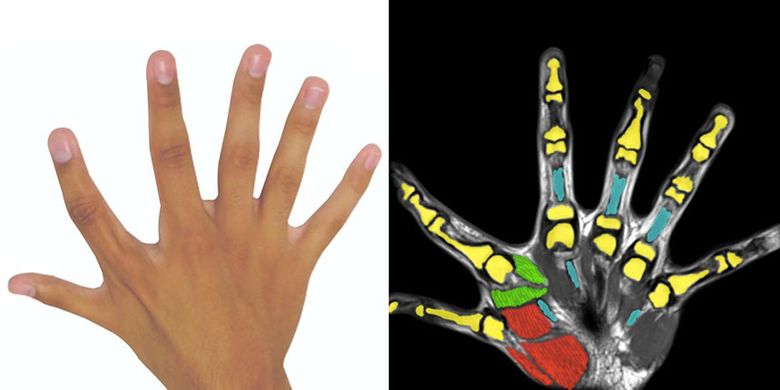Hasil pindaian tangan pengidap polidaktili yang menunjukkan bahwa jari ekstra digerakkan oleh otot tersendiri 