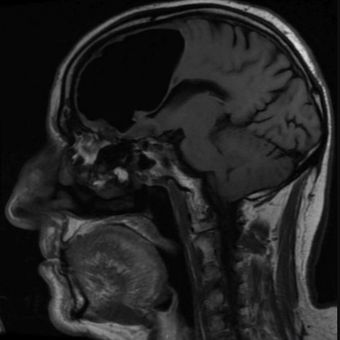 Seorang lansia di Irlandia Utara sering jatuh dengan penyebab tak biasa. Lewat hasil MRI, diketahui ia memiliki kantung udara berukuran 9 cm di bagian depan kanan otak, yang disebut pneumatocele. 