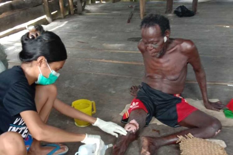 Pelayanan yang dilakukan oleh YASA terhadap penderita Kusta di Kabupaten Asmat, Papua, Senin (14/6/2021)