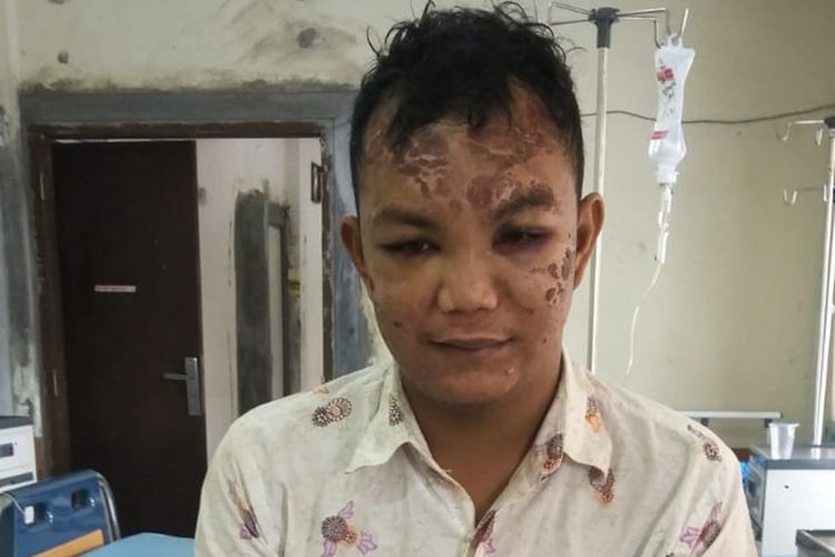 Harismail alias Ujang (25) korban aksi salah tangkap yang diduga dilakukan oleh oknum polisi kondisinya kini mulai membaik setelah empat hari menjalani perawatan di rumah sakit Bhayangkara Palembang, Selasa (26/2/2019).