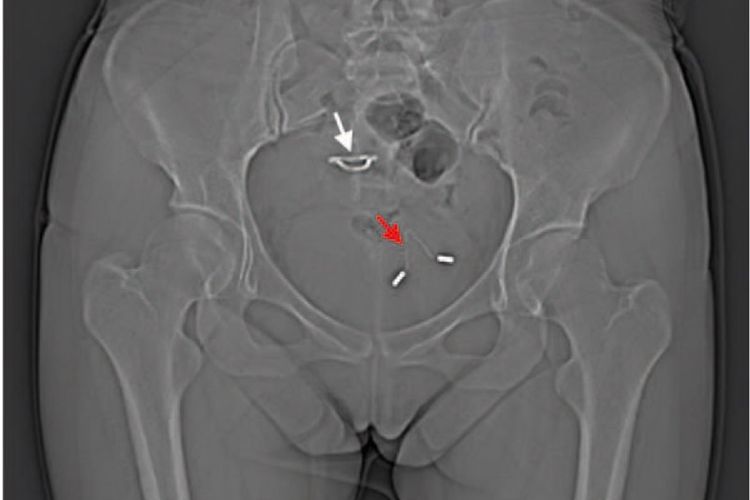 An X-ray showing a womans displaced IUD in her bladder. The red arrow points to the IUD in the bladder, while the white arrow points to a second IUD inserted in the uterus.