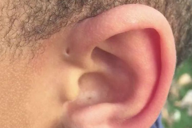 Sebagian kecil manusia dilahirkan dengan lubang kecil di atas daun telinga, lubang apakah itu?