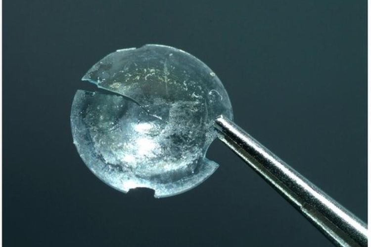 Lensa kontak yang sudah rusak ditemukan bersarang di kelopak mata seorang perempuan selama 28 tahun.