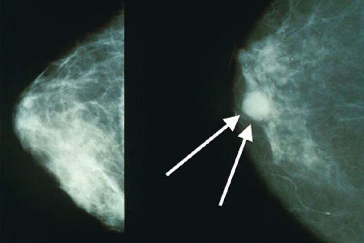 Citra tumor pada payudara dengan mamografi.