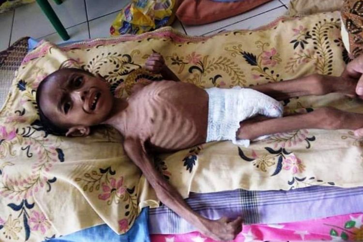 Intan Zahar (4) penderita gizi buruk akut (marasmus) di Desa Kuala Keureto, Kecamatan Lapang, Kabupaten Aceh Utara, Rabu (16/1/2019)