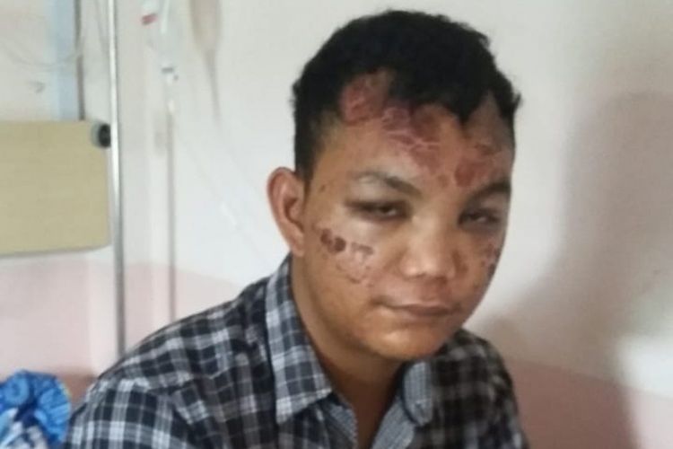 Harismail alias Ujang (25) yang menjadi korban salah tangkap ketika menjalani perawatan di RS Bhayangkara Palembang, Sumatera Selatan, Senin (25/2/2019).