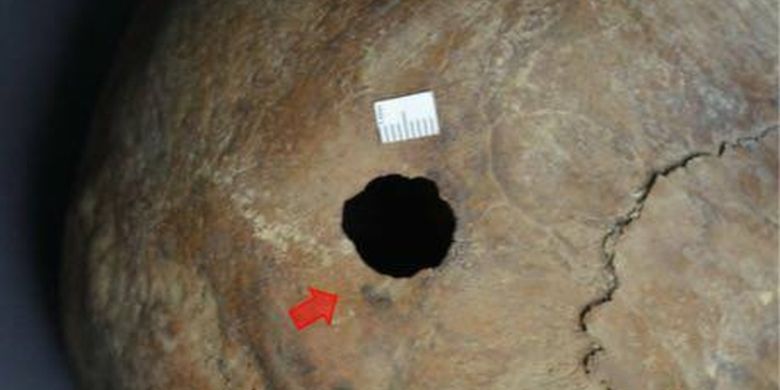 Dalam peti mati kuno atau sarkofagus hitam yang terbuat dari batu granit, ahli menemukan tiga tengkorak, dua pria dan perempuan. Pada salah satu tengkorak pria, ditemukan lubang hitam di tengkorak kepalanya.