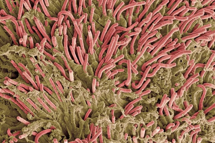 Fusobacterium (merah), bakteri yang ada di mulut, juga ditemukan di setengah dari semua tumor usus besar. Dia ikut melakukan perjalanan dengan kanker ke tempat lain di tubuh.