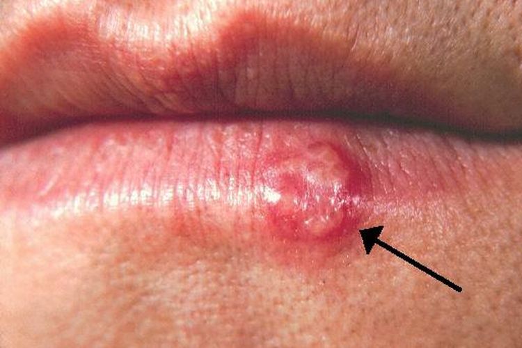 Kemunculan lesi di bibir, gejala penyakit herpes labialis yang disebabkan oleh virus HSV-1