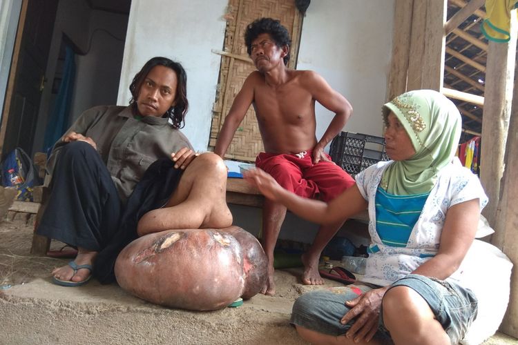 Tasmuni (28) warga Dusun Tembelang Desa Bareng Kecamatan Kabat yang kakinya membesar hinga seberat 60 kilogram beserta kedua orangtuanya. 