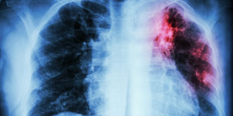 Rontgen dada: infiltrasi interstisial pada paru-paru bagian atas kiri karena infeksi Mycobacterium Tuberculosis