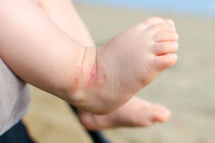 Ilustrasi eczema pada bayi