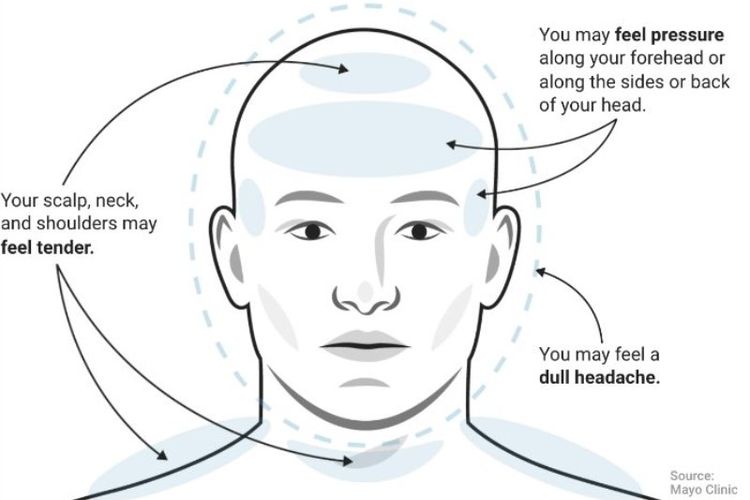 Ilustrasi sakit kepala tegang