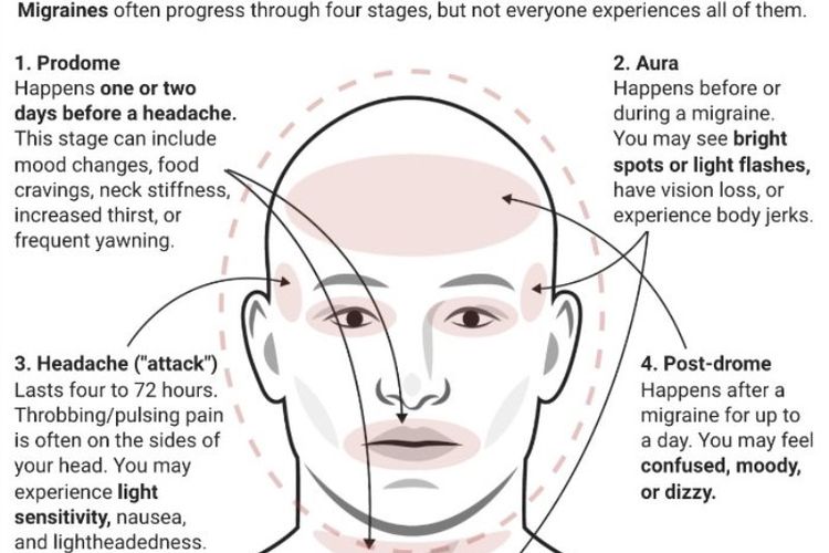 Ilustrasi migrain