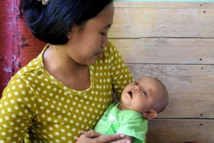 Seorang bayi yang masih berusia 5 bulan di Desa Mega Bahari, Kecamatan Lasalimu Selatan, Kabupaten Buton, Sulawesi Tenggara, didiagnosa terkena penyakit campak rubella. Akibat penyakit campak rubella ini,  kini bayi yang bernama Sidik Hendrawan, mengalami kebutaan katarak kongenital dan kelainan jantung.