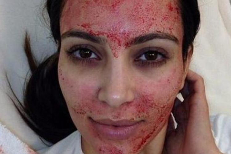 Kim Kardashian lakukan perawatan Vampire Facial