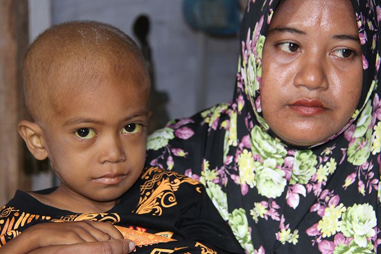 Muhammad Arief Billah (5) bocah penderita kanker hati (Hepatoblastoma) anak dari pasangan Sakdiah (30) dan Ahmadallah (35) warga kurang mampu Desa Laksamana, Kecamatan Jeumpa, Kabupaten Bireuen, Aceh kondisi kesehatannya semakin memburuk, keluarga berhadap ada pihak yang mau membantu biaya untuk pengobatan untuk dibawa ke Rumah Sakit di Jakarta, Minggu (12/11/17)