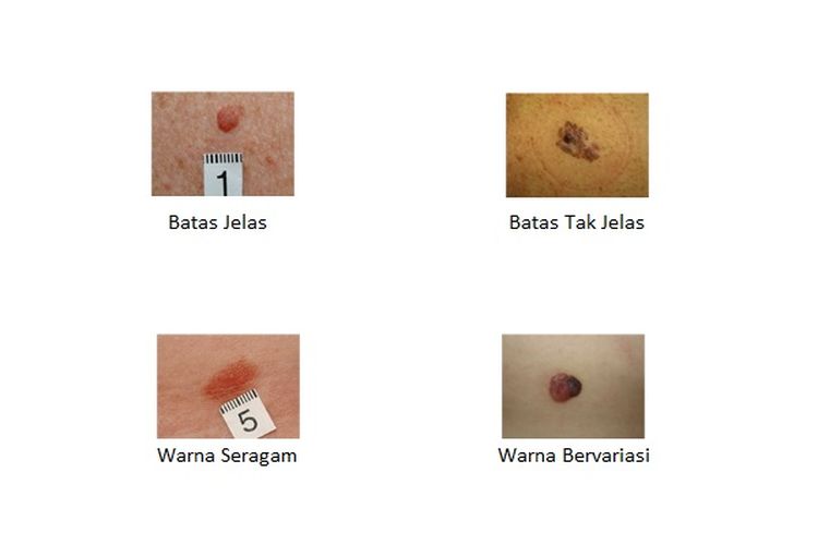 Tahi lalat tanda melanoma, batas tak jelas warnanya bervariasi.