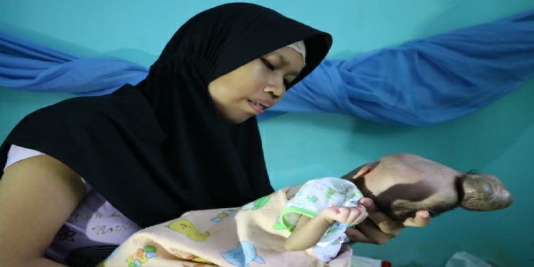 Bayi Lintang digendong ibunya saat sakit pada benjolan di bagian kepala mulai terasa.