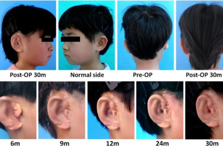 Setelah 30 minggu, anak dengan mikrotia memiliki telinga hampir normal