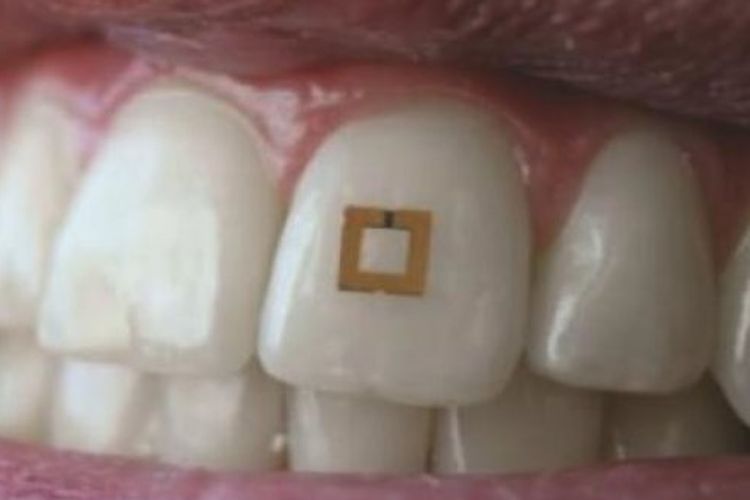 perangkat sensor mini yang dipasang di gigi