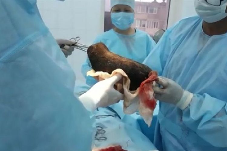 Inilah gumpalan rambut yang dikeluarkan dokter di Kazakhstan dari perut gadis berusia 12 tahun. Dokter harus melakukan operasi setelah si gadis mengeluh sakit perut dalam dua tahun terakhr.