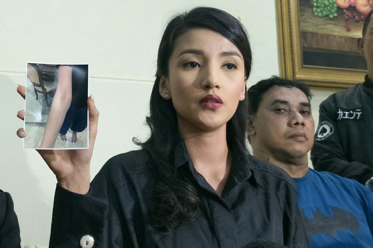 Artis peran Tsania Marwa saat menunjukkan luka di lengannya dalam jumpa pers di kawasan Gambir, Jakarta Pusat, Selasa (19/3/2019).