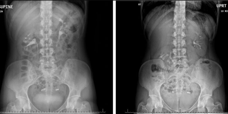 Hasil CT Scan seorang perempuan yang ginjalnya turun sampai panggul. Hasil CT Scan kiri, diambil saat perempuan itu berbaring dan terlihat letak ginjalnya normal. Hasil CT Scan kanan, diambil saat berdiri da menunjukkan ginjal kanannya (terlihat di sebelah kiri dalam hasil CT Scan) jatuh ke panggul. Ginjal kiri (terlihat di sebelah kanan dalam pemindaian) berada di bawah tulang rusuk.
