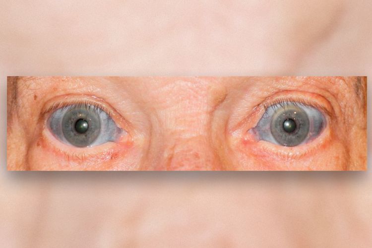 Seorang pria berusia 70 tahun mengalami perubahan warna pada bagian putih mata atau sklera. Bukan putih, sklera mata ini biru. 
