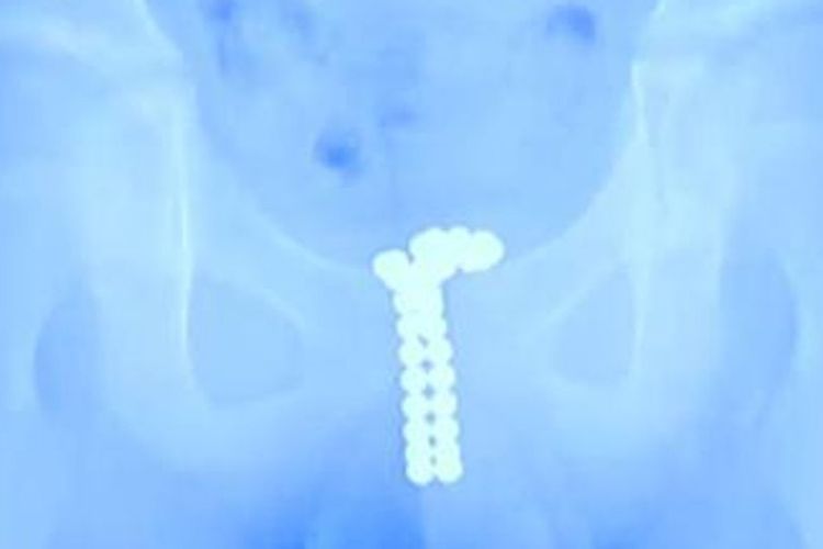 Gambar sinar X menunjukkan adanya bola magnet dalam penis bocah 12 tahun di China.