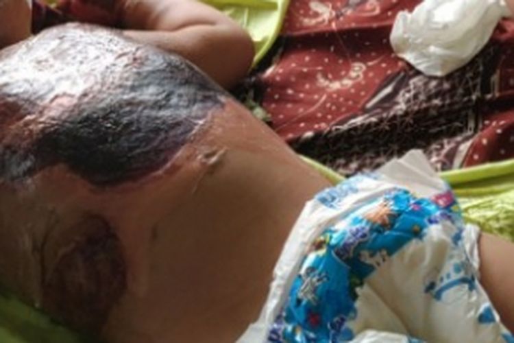 Alula Farzana Ayunindia, bayi yang menderita penyakit kulit misterius, kondisinya terus memburuk di RSUD Dr Slamet Martodirdjo, Pamekasan.