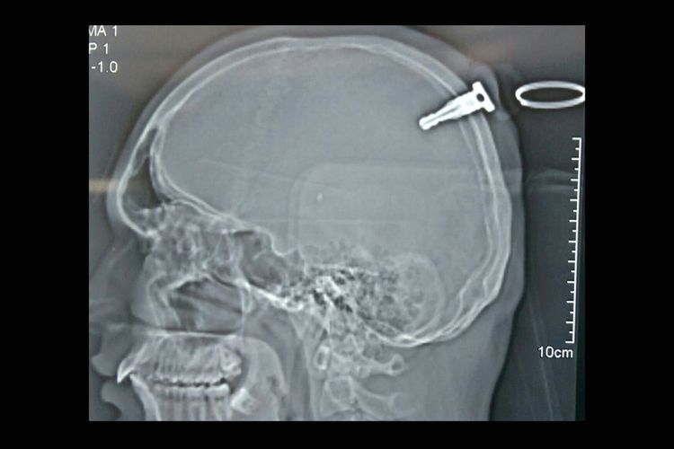 Hasil CT Scan menunjukkan ada kunci sepeda motor bersarang sedalam 1,5 inci di tengkorak. Setelah operasi selama 3,5 jam, kunci itu sukses diambil dari otak.